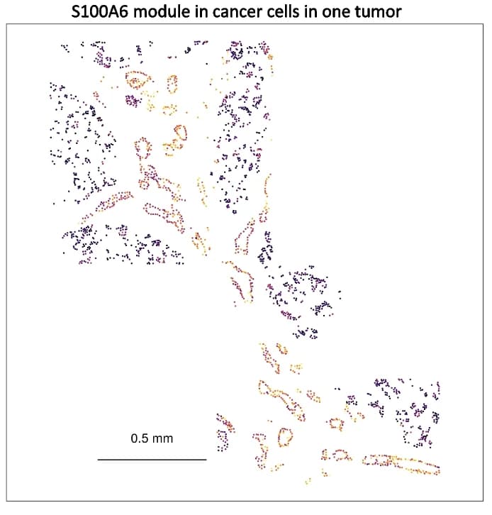 Open access visualization of Microscopy, S100A6 Module Genes, Cancer Cells, Tumor