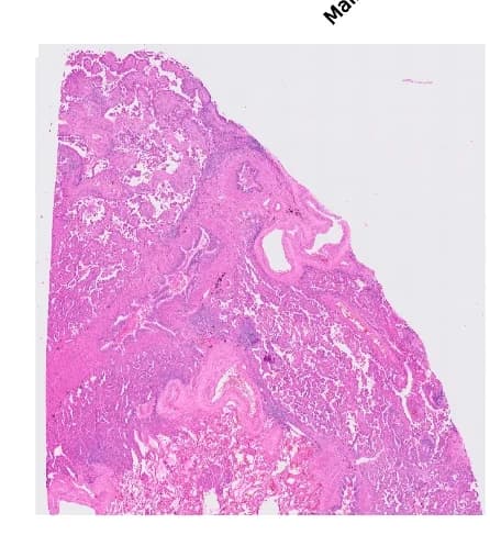 Open access visualization of Microscopy, Lung Adenocarcinoma, LUAD