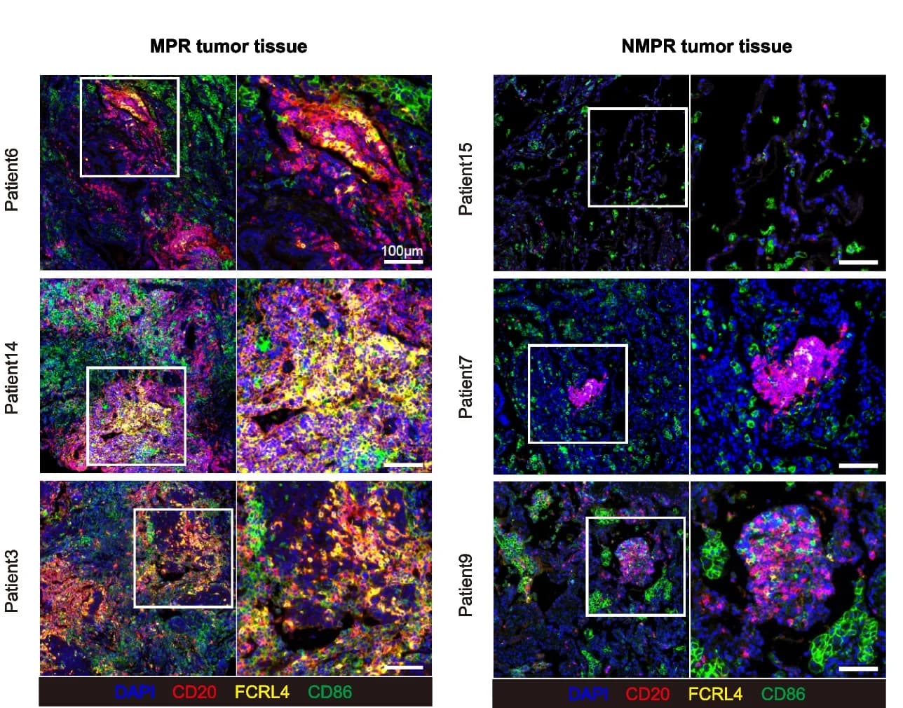 Open access visualization of Microscopy, In Situ Multiplex Immunofluorescence, B4_FCRL4 Cells, MPR Tumor Tissues, NMPR Tumor Tissues