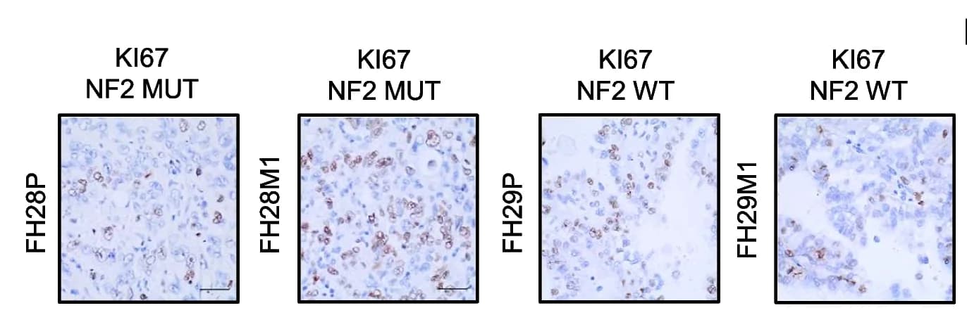 Open access visualization of Microscopy, KI67 Staining, NF2 Mutation, Metastatic Lesions, Wild-Type