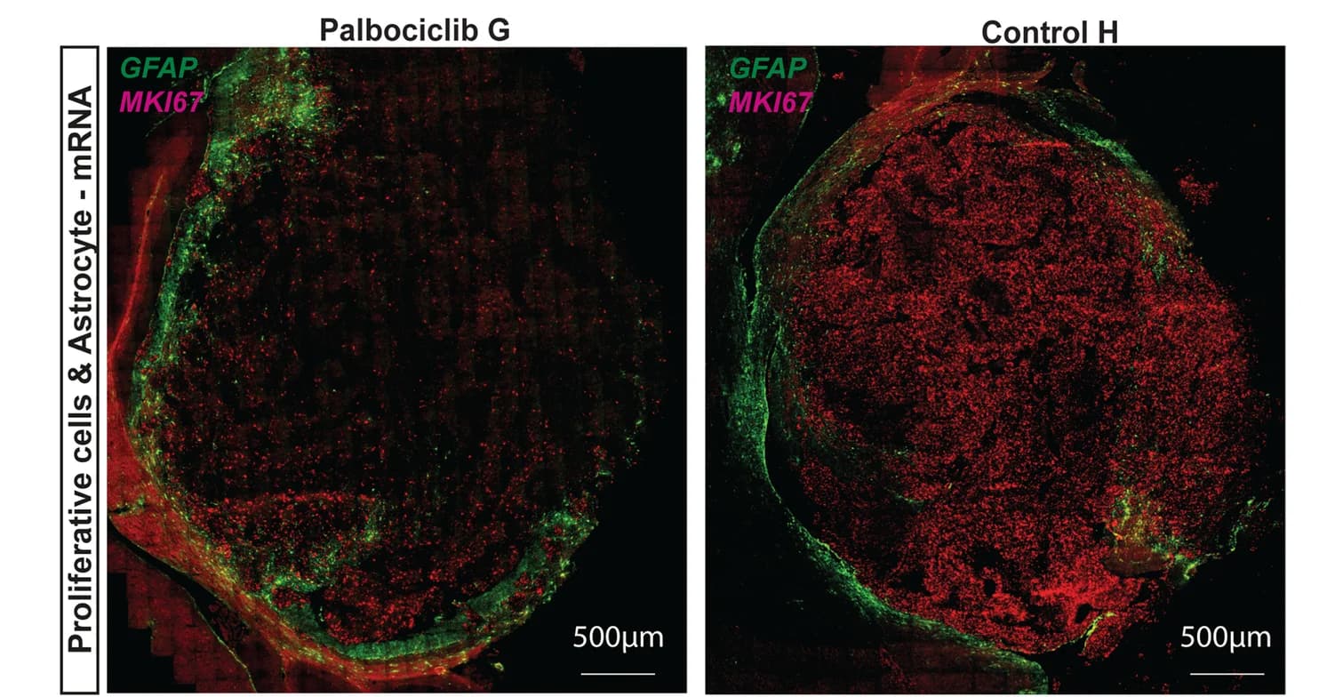 Open access visualization of Microscopy, Proliferating Cells, Ki67, Tumor, Tumor-Mouse Interface