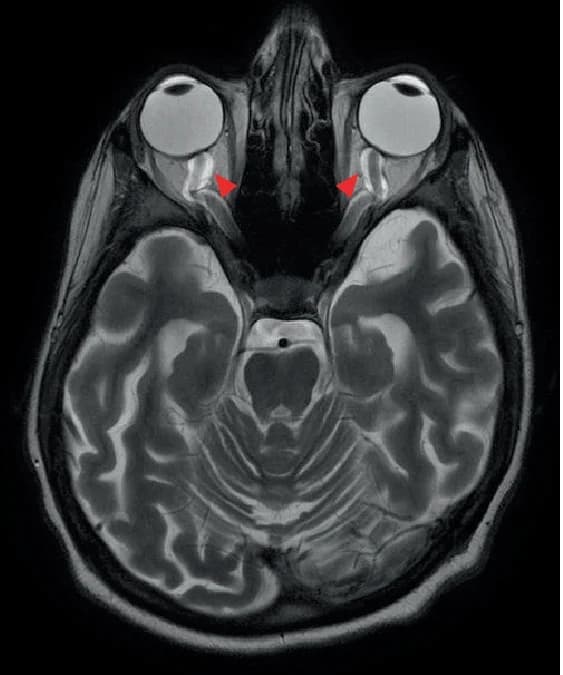 Open access visualization of Microscopy, Brain MRI, Brain Atrophy, CSF Spaces, Optic Nerves
