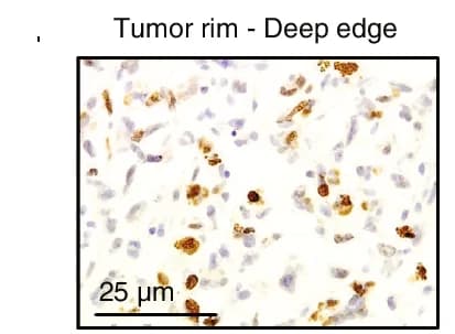 Open access visualization of Microscopy, Ki67 Immunohistochemistry, Tumor Rim, Proliferating Cells, GBM