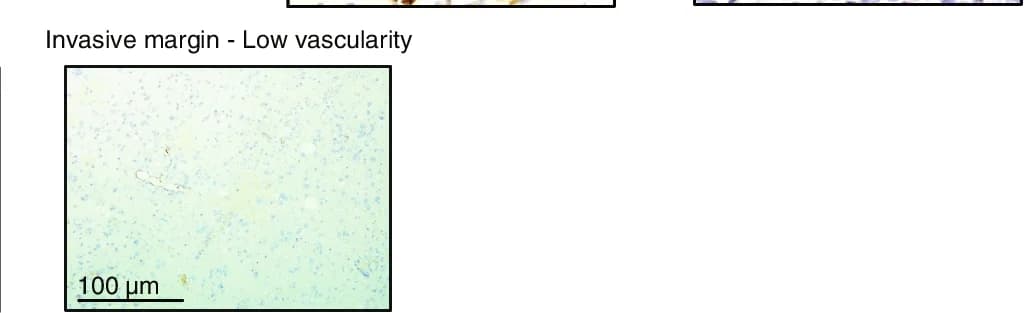 Open access visualization of Microscopy, CD31 Immunohistochemistry, Tumor Vascularity, Invasive Margin