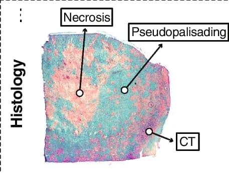 Open access visualization of Microscopy, H&E stained tissue, Patient, Necrotic core, Pseudopalisading cells
