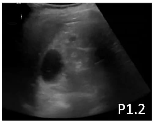 Open access visualization of Microscopy, Echogenicity, Nephrocalcinosis, Cysts