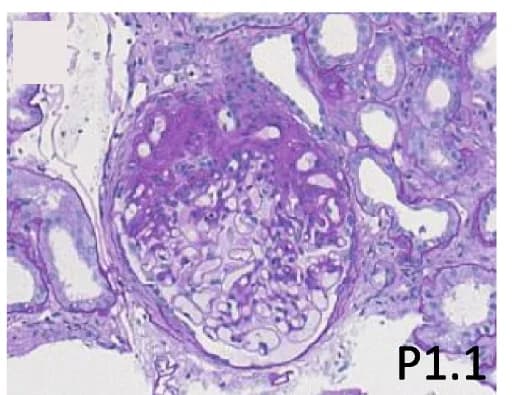 Open access visualization of Microscopy, Histology, Kidney Biopsy, Focal Segmental Glomerulosclerosis