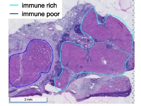 Open access visualization of Microscopy, Spatial Transcriptomics, Tumor Heterogeneity, Immune-rich Region, Immune-poor Region