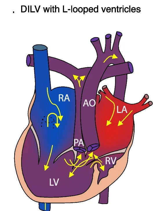 Open access visualization of Illustration, Double Inlet Left Ventricle, L-Looped Ventricles, Dextrocardia, Levocardic