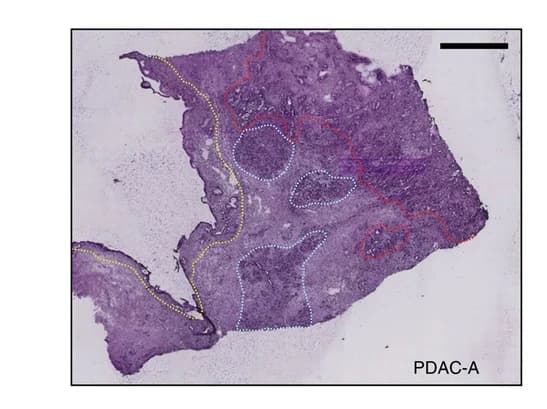 Open access visualization of Microscopy, Histological Annotation, Cancer Cells, Desmoplasia, Duct Epithelium