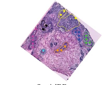 Open access visualization of Microscopy, Histological Annotation, Tissue Section, Invasive Ductal Cancer, Ductal Cancer In Situ