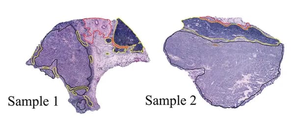 Open access visualization of Microscopy, Histological Annotations, Melanoma, Lymphoid, Stroma