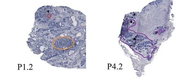 Open access visualization of Microscopy, Histological Annotations, Prostate Cancer, Prostatic Intraepithelial Neoplasia, Chronic Inflammation