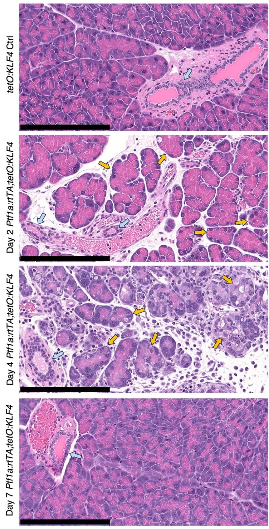 Open access visualization of Microscopy, Hematoxylin and Eosin Staining, Pancreas, Normal Ducts, Acinar-Ductal Metaplasia