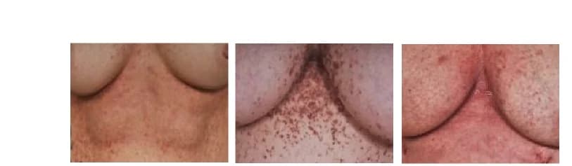 Open access visualization of Photo, Darier's Disease, Submammary Skin, Objective DD Scores