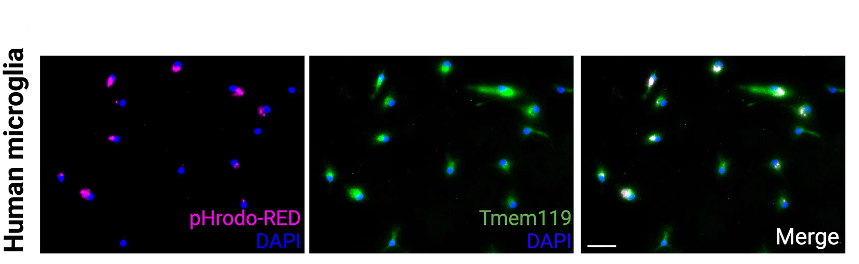 Plot showing: Microscopy, Immunocytochemistry, Microglia, Peritumoral Tissue, TMEM119