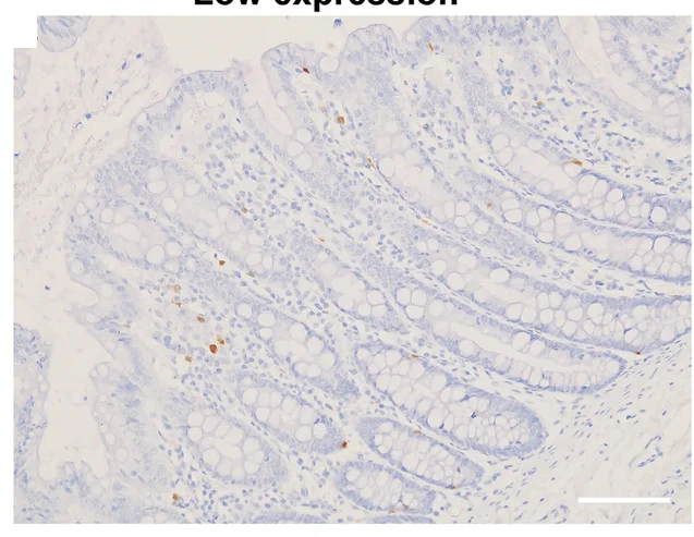 Plot showing: Microscopy, CD8+ T Cells, Immunohistochemistry, CRC Tissue