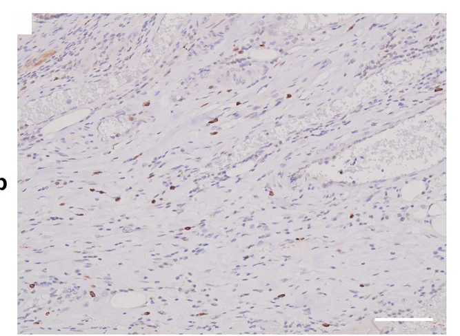 Plot showing: Microscopy, CD66b+ Neutrophils, Immunohistochemistry, CRC Tissue