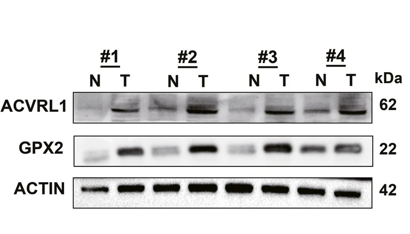 Plot showing: Gel, Protein Level, ACVRL1, GPX2, CRC Tissues
