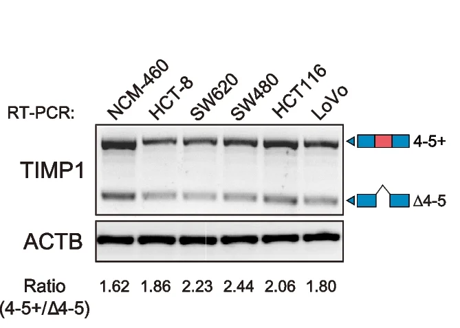 Plot showing: Gel, RT-PCR, TIMP1, CRC Cancer Cell Lines, Normal Colon Mucosal Epithelial Cell Line